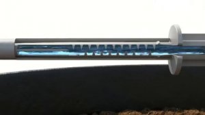 Установка Внешняя капельница