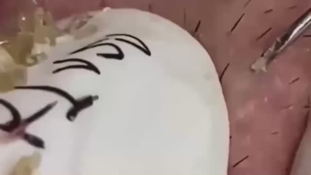 #304 Чистка лица от угрей и акне. Выдавливание прыщей. Удаление черных точек и комедонов