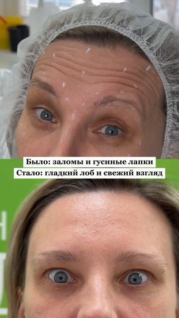 Ботулинотерапия Релатокс: до и после