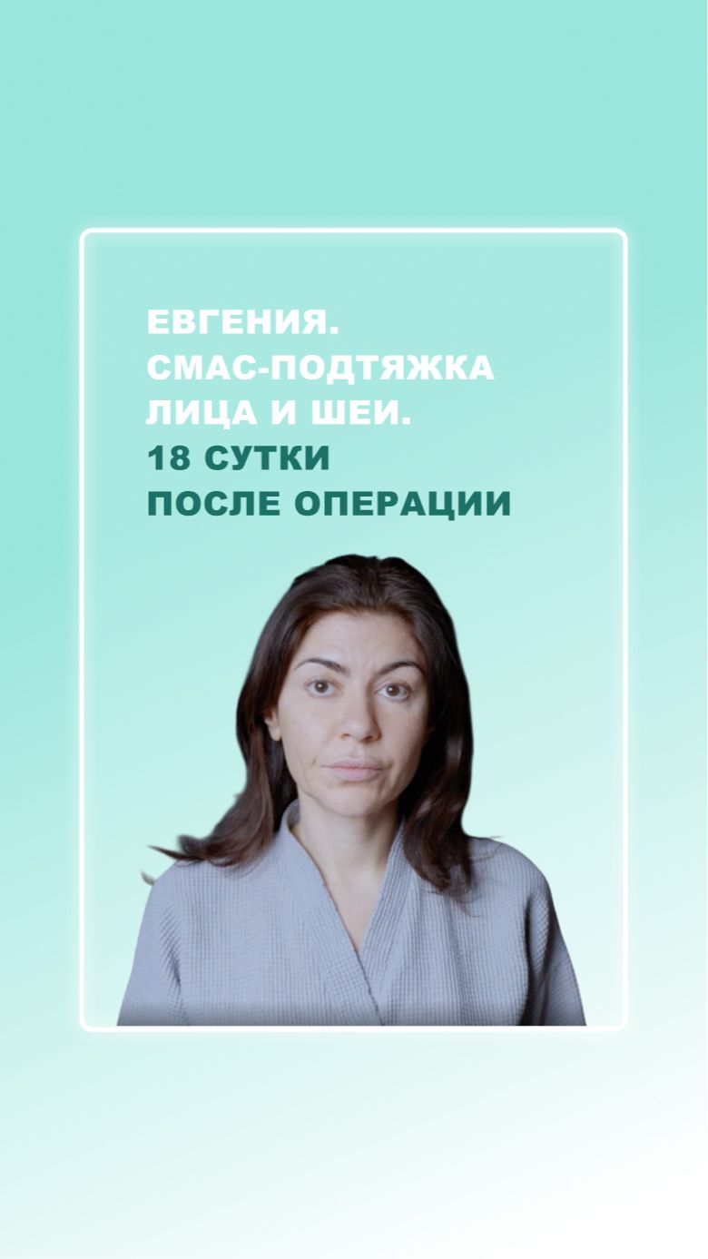 Евгения. СМАС-подтяжка лица и шеи. 18 сутки после операции