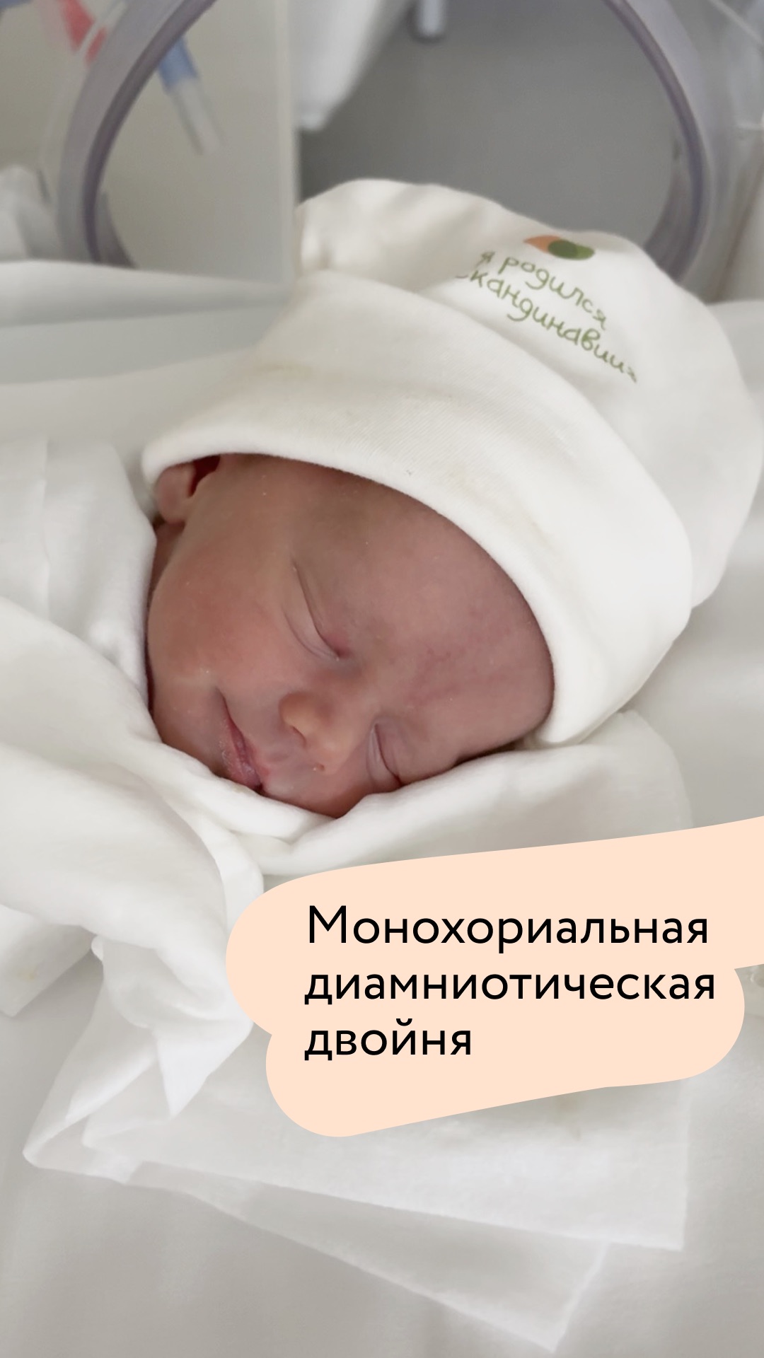 Пациентка обратилась к нам при сроке беременности 32 недели с монохориальной диамниотической двойней