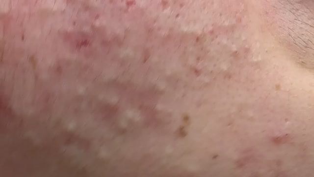 Удаление акне и лечение прыщей