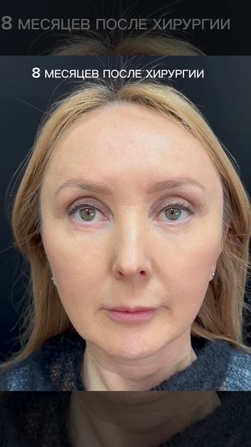 8 месяцев после операции эндоскопический лобно-височный лифтинг