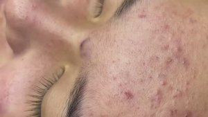 112 • Acne collection • АСМР • Relax Spa