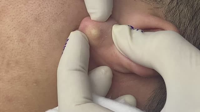 Глубокое удаление образования на ухе. ASMR для релаксации.