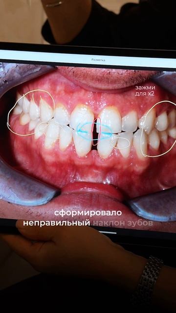 Когда хотел виниры, а оказалось — дело глубже 🦷