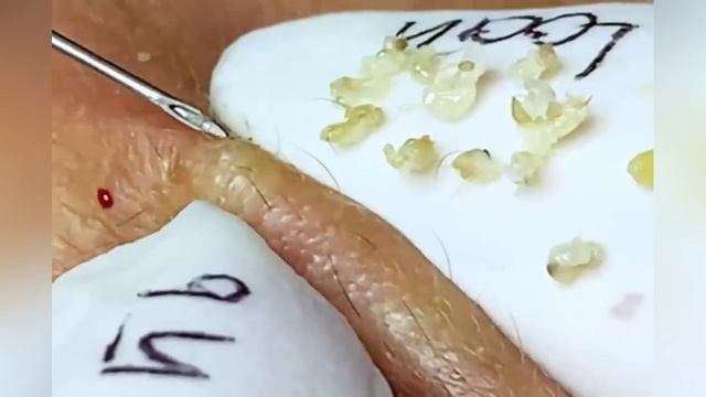 Выдавливание прыщей угрей черных точек и камедонов 405