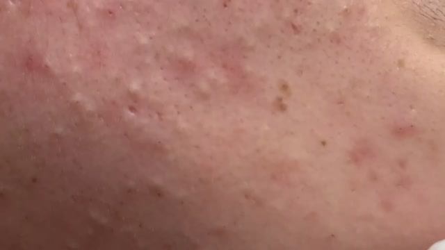 Удаление акне и лечение прыщей