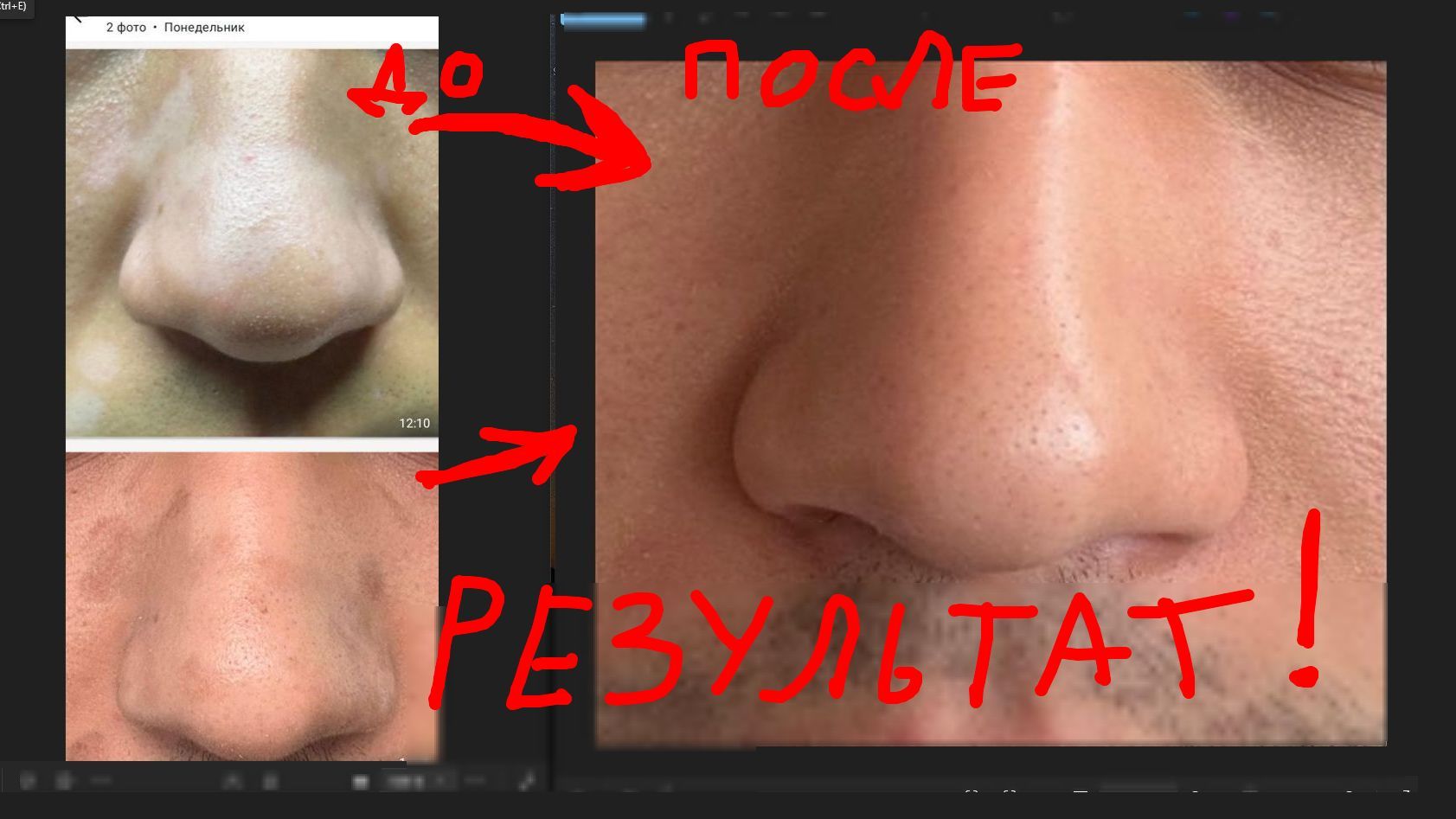 ИЗБАВИЛСЯ ОТ ВИТИЛИГО ЗА 4 МЕСЯЦА! Отзыв клиента