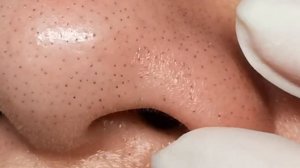 #305 Чистка лица от угрей и акне. Выдавливание прыщей. Удаление черных точек и комедонов