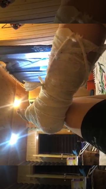 Поломал ногу