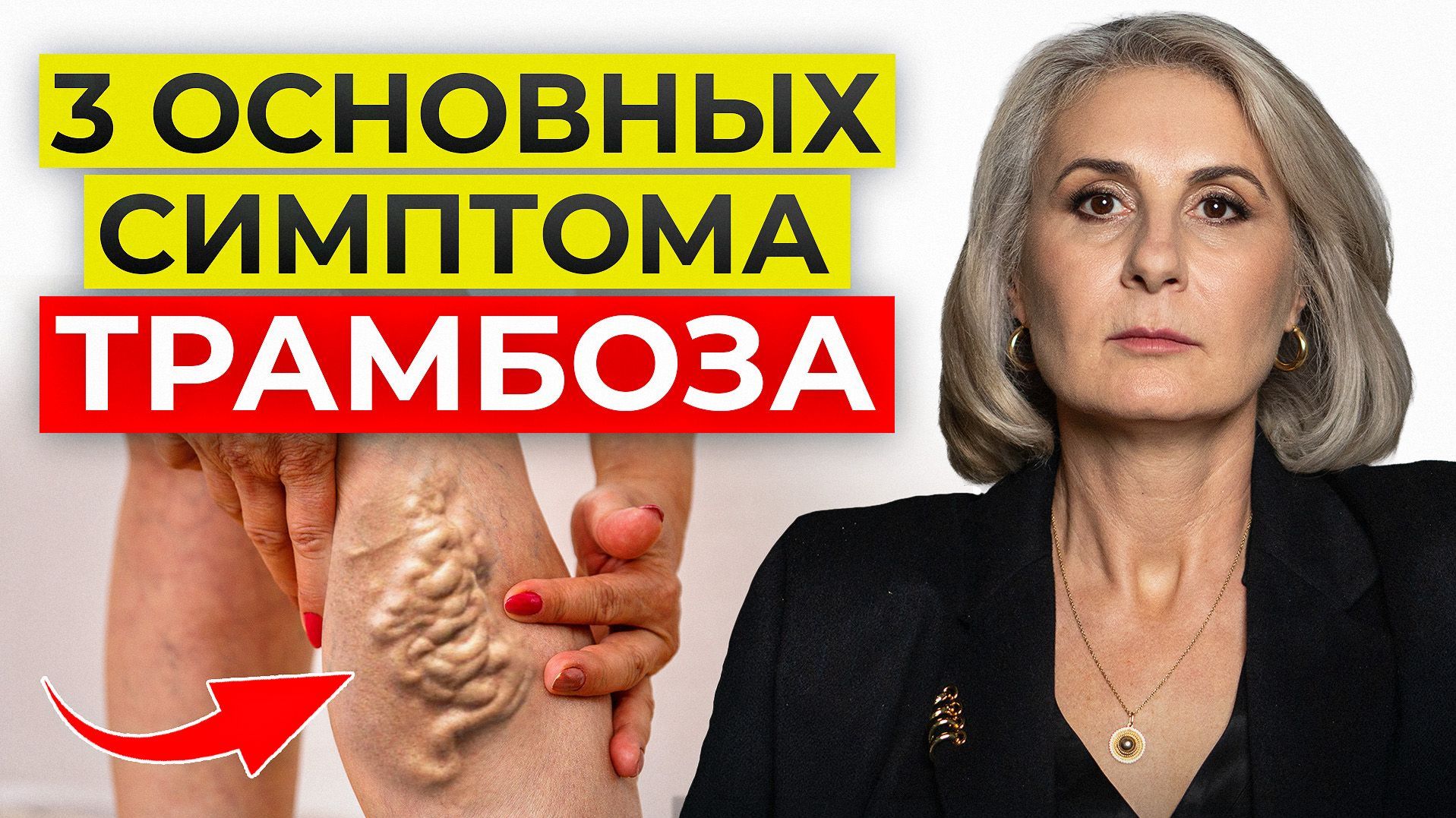 ЭТИ признаки тромбоза нельзя игнорировать! / Как ИЗБЕЖАТЬ инфаркта и инсульта?