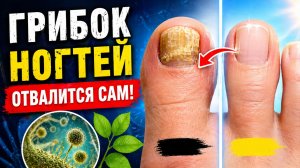 БЕЗ ОПЕРАЦИИ! САМ ОТПАДЕТ ГРИБОК НОГТЕЙ! Четыре частые ошибки и эффективный домашний рецепт!