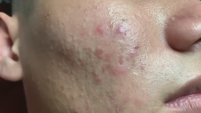 Удаление подкожных прыщей #025