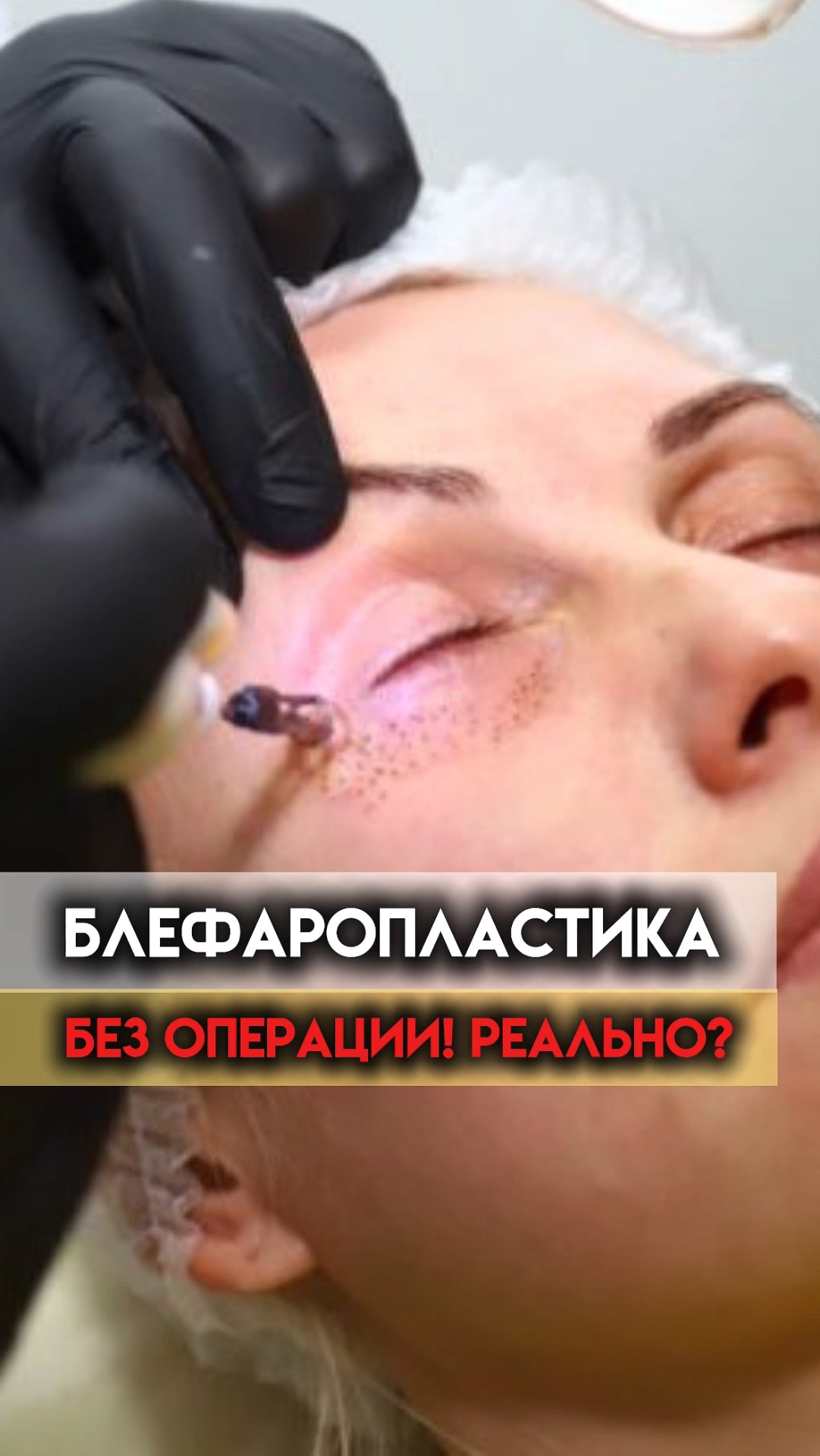 Блефаропластика в кабинете косметолога  миф или реальность?