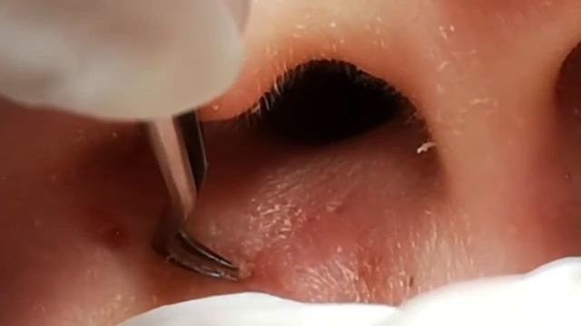 #306 Чистка лица от угрей и акне. Выдавливание прыщей. Удаление черных точек и комедонов