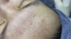 109 • Acne collection • АСМР • Relax Spa