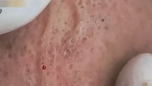 Удаление гигантских комедонов. Удовлетворение гарантировано. 2151