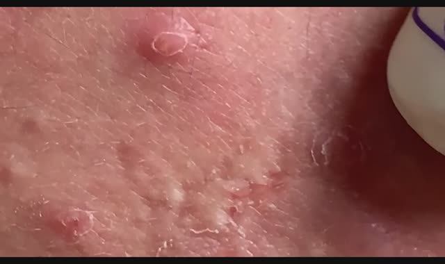 Извлечение содержимого прыщей. Полное удаление корня