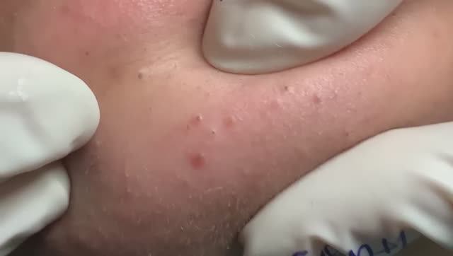 Воспалительное акне с отёком лица