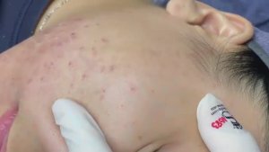110 • Acne collection • АСМР • Relax Spa
