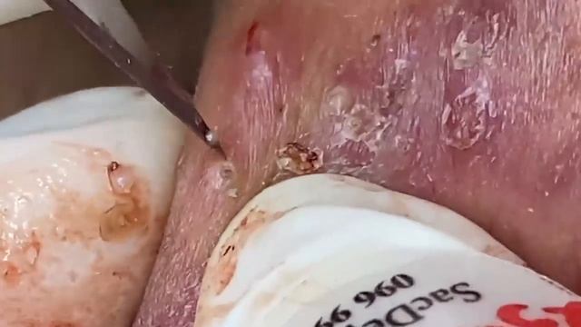 Выдавливание прыщей, угрей, черных точек и камедонов #404