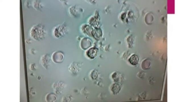 Псориаз Иммунитет Трансфер Фактор