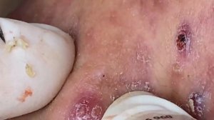 Выдавливание прыщей, угрей, черных точек и камедонов #403