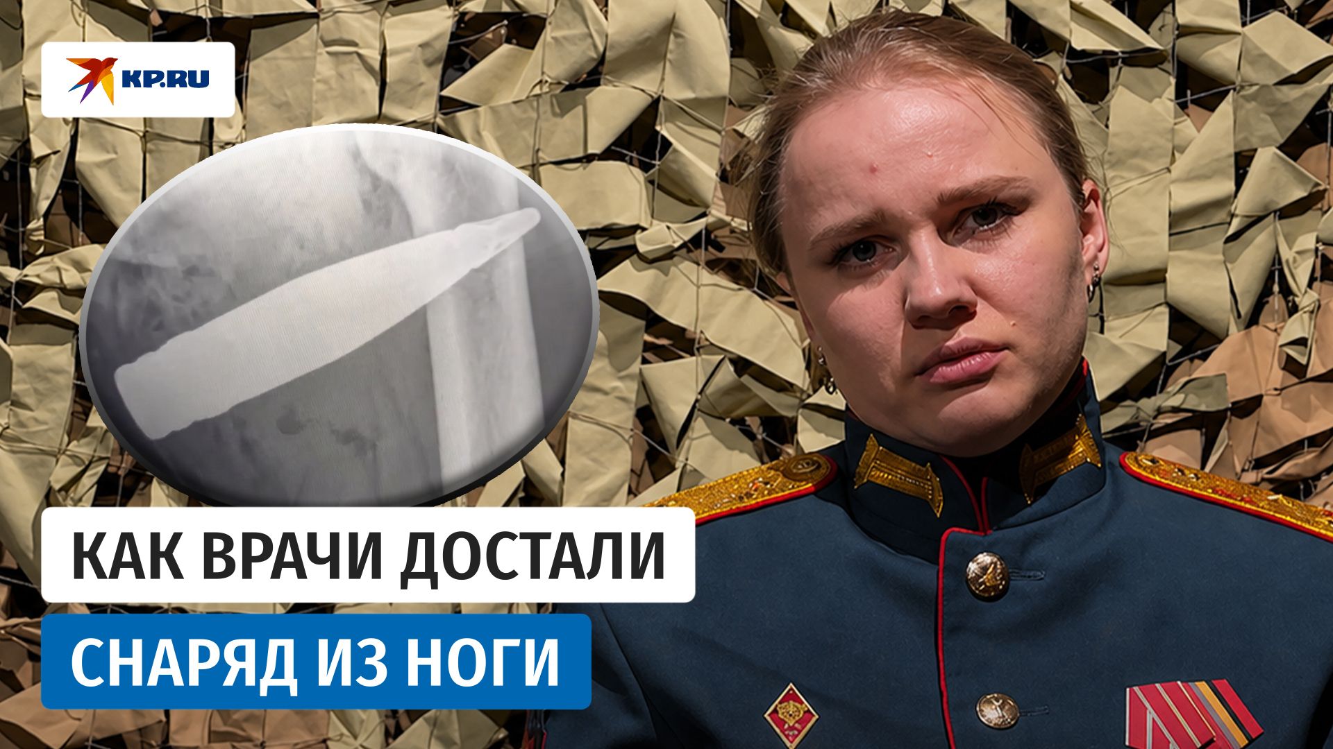Как хирурги достали из бедра солдата СВО 30-мм снаряд