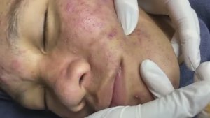 Лицо в ужасных прыщах. Постепенное очищение. Часть 2