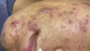Лицо в ужасных прыщах. Постепенное очищение. Часть 1