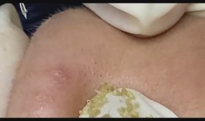 Чистка лица от прыщей в спа. Часть 2