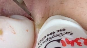 Выдавливание прыщей, угрей, черных точек и камедонов #407