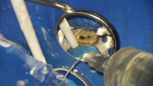 Удаление титановых анкерных штифтов и перелечивание с постэндовосстановлением в одно посещение.