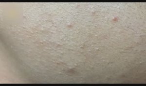 Очищение проблемной кожи от акне