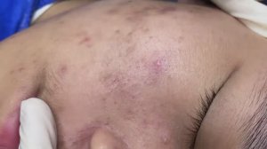 113 • Acne collection • АСМР • Relax Spa
