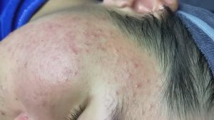 115 • Acne collection • АСМР • Relax Spa