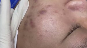 114 • Acne collection • АСМР • Relax Spa