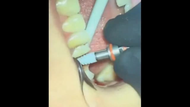 Установка 2х имплантатов. (2)