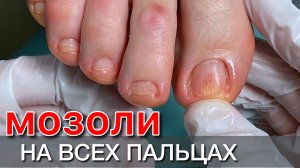 она носила ТУФЛИ 🙈  теперь обрабатываем подногтевые мозоли на всех пальцах