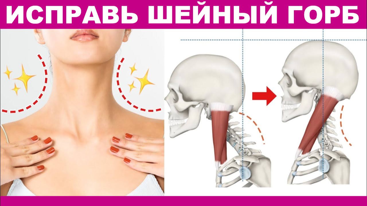 Как исправить шейный горб и сделать лицо худым.