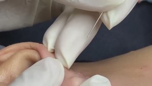 Удаление внутренних образований за ухом