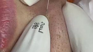Удаление жирных пробок со всего лица