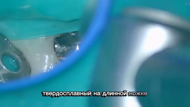 Извлечение отломка винта из шахты имплантата.
