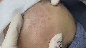 119 • Acne collection • АСМР • Relax Spa