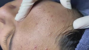 117 • Acne collection • АСМР • Relax Spa