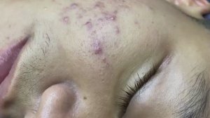 118 • Acne collection • АСМР • Relax Spa