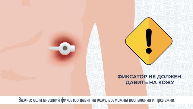 Проблемы в уходе за гастростомой