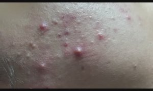 Выдавливание прыщей и удаление чёрных точек