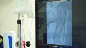 В КБР хирурги впервые заменили пациенту клапан сердца без разреза